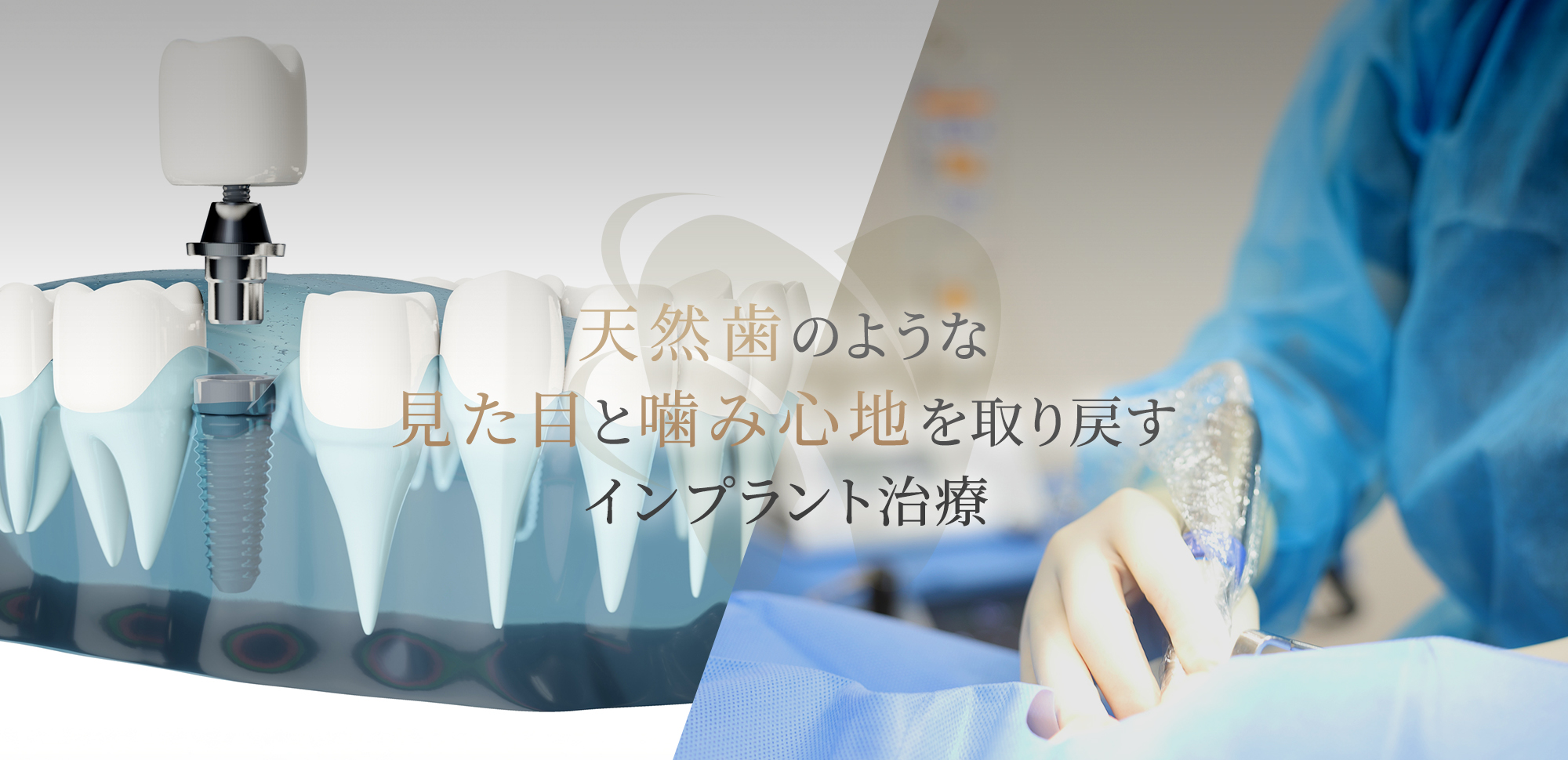 天然歯のような見た目と噛み心地を取り戻すインプラント治療