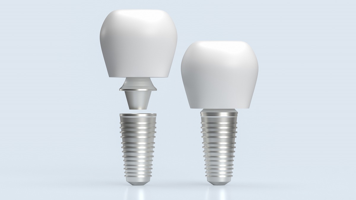 どうしてインプラント治療がいいの？