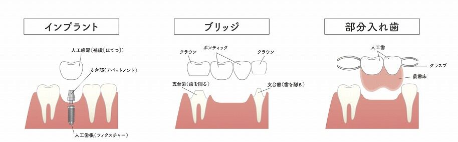 他の治療法と比較してわかるインプラントの特長