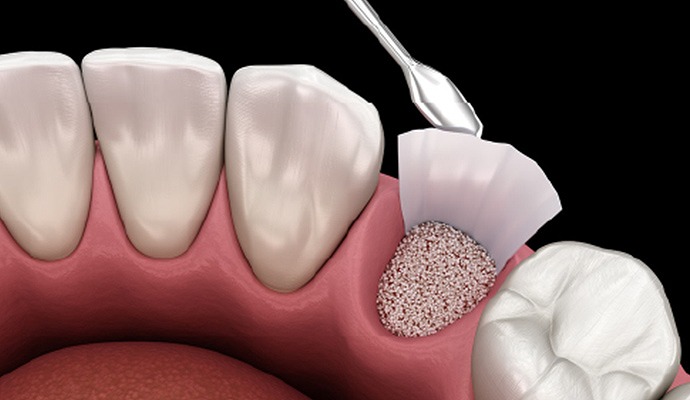 GBR（骨誘導再生法）