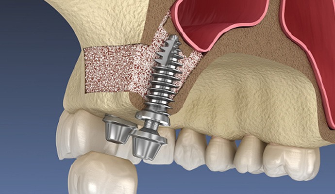 サイナスリフト法（上顎洞底拳上術）