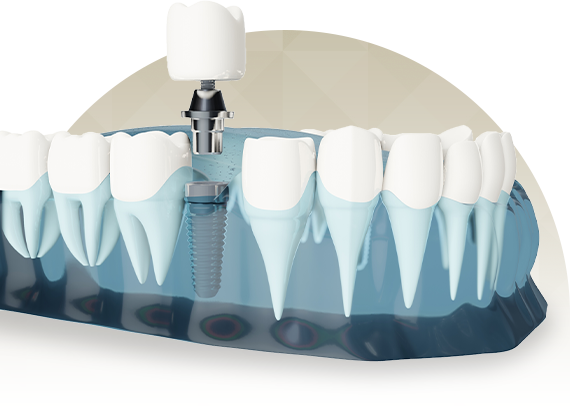 インプラント治療とは