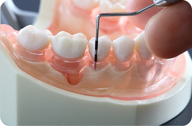 インプラントと歯周病