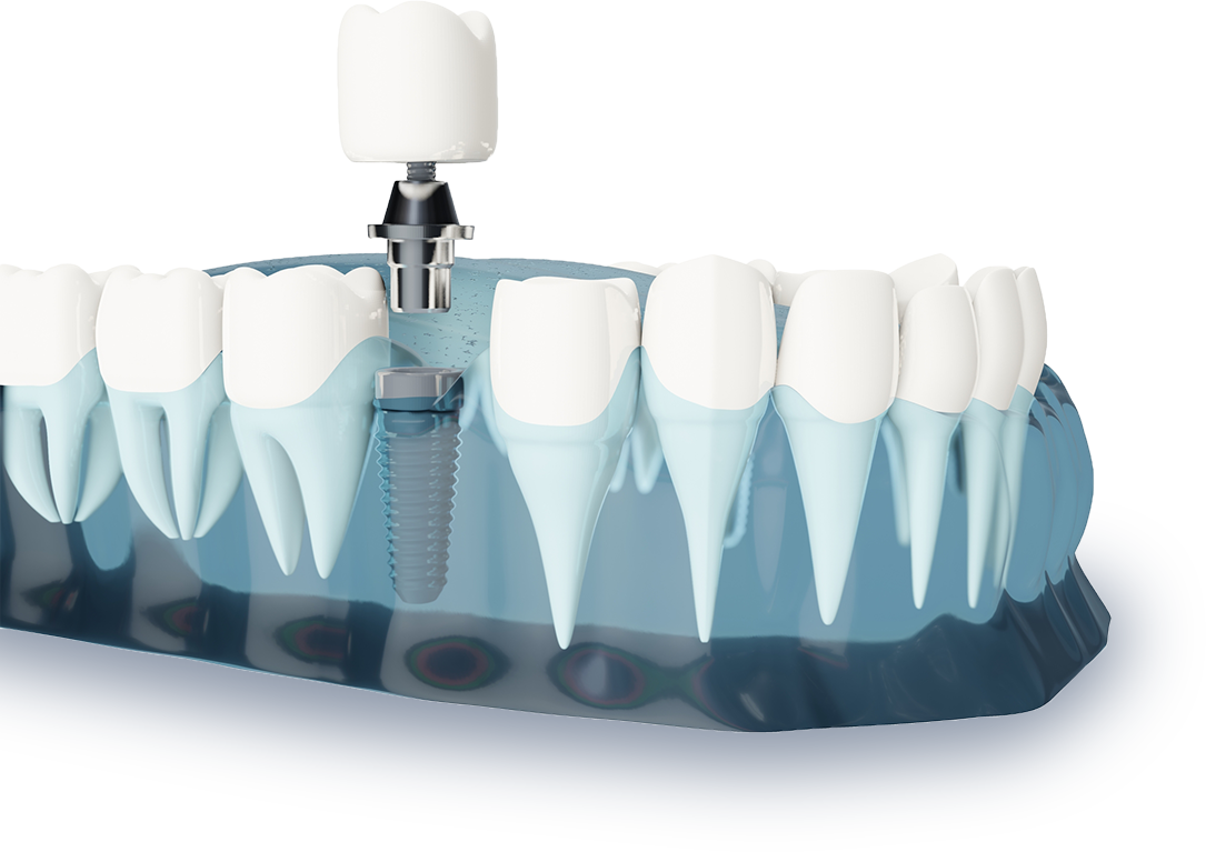 インプラント治療