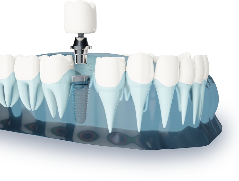 インプラント治療